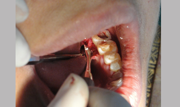 Root canal treatment in Anand
                        